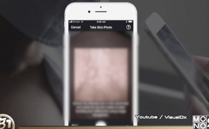 แอปฯ ช่วยวินิจฉัยโรคผิวหนัง