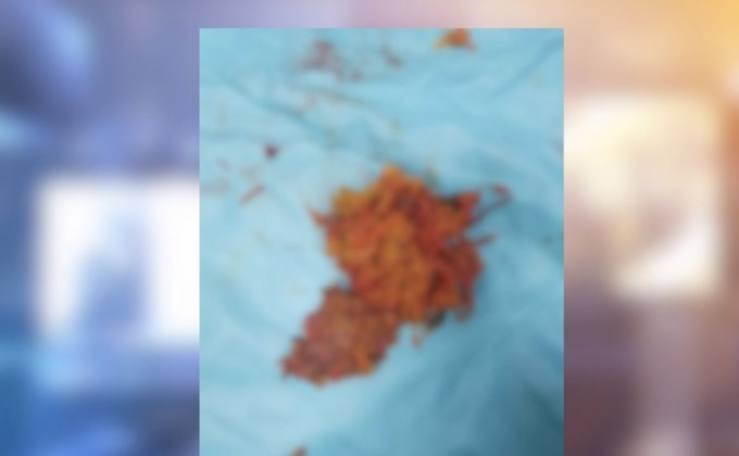 แพทย์โพสต์เตือนพบก้อนอาหารที่กลืนโดยไม่เคี้ยว-หวั่นอันตราย