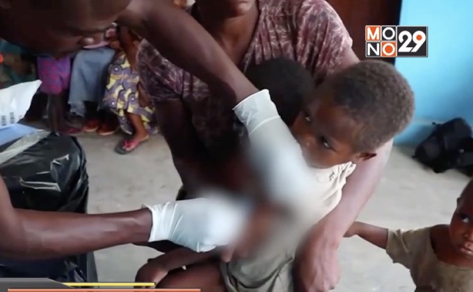 4 ชาติยุโรปถูกถอดจากสถานะปลอดโรคหัด