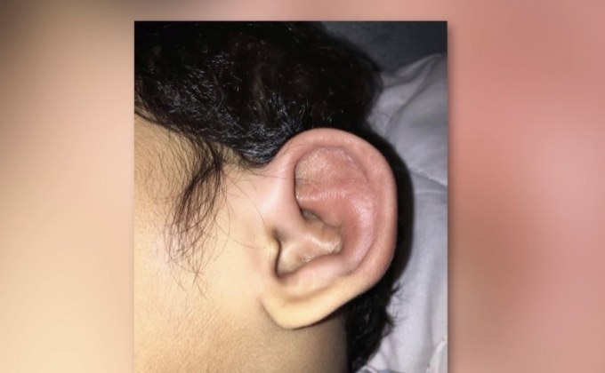 เตือนภัยนอนใกล้ห้องน้ำตะขาบเข้าหู