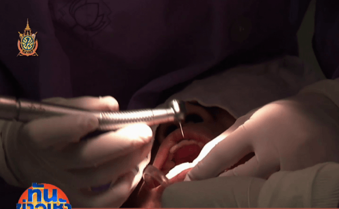 บอร์ด สปส.เห็นชอบไม่ต้องสำรองจ่ายค่าทำฟัน