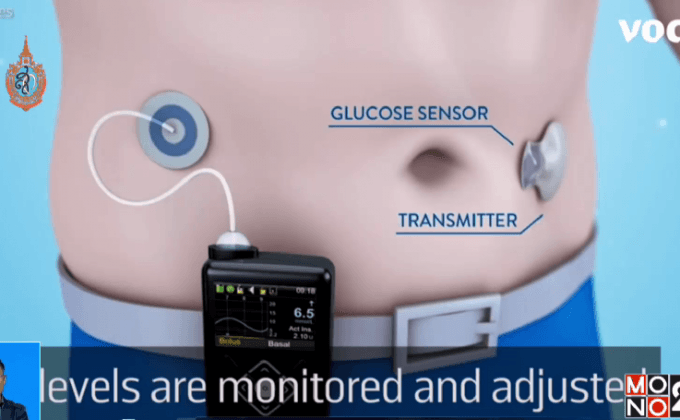 FDA สหรัฐฯ รับรองตับอ่อนเทียมรุ่นแรก