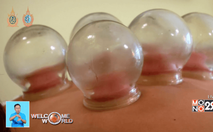 การครอบแก้ว-เทรนด์ใหม่ของนักกีฬาโอลิมปิก