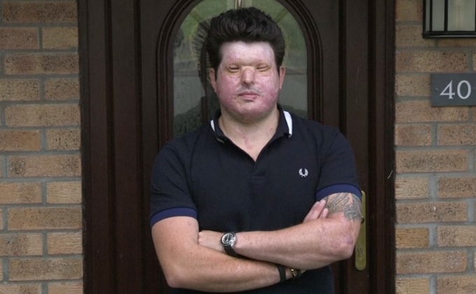 เหยื่อสาดน้ำกรดในอังกฤษเผยวินาทีชีวิต