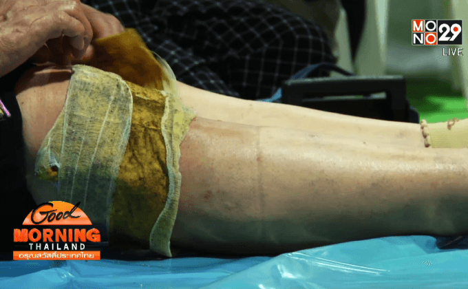 ยาพอกดูดพิษบรรเทาอาการปวดข้อ