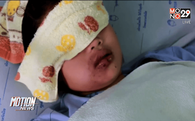 เด็กอยุธยาดัดฟันไม่ได้มาตรฐานจนปากบวมเน่า