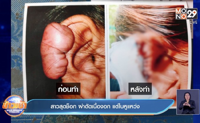 สาวสุดช็อก ผ่าตัดเนื้องอก แต่ใบหูแหว่ง