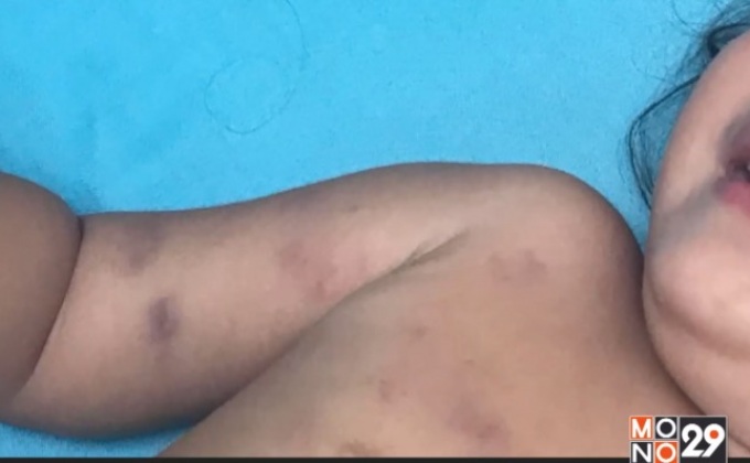 แม่ร้องสื่อฯ ครูทำร้ายลูกวัย 2 ขวบ ช้ำทั้งร่างกาย