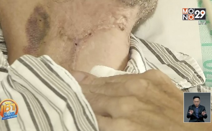 แพทย์โปแลนด์ประสบความสำเร็จ “ปลูกถ่ายลำคอ”