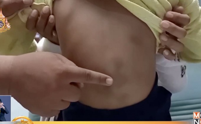 จับแล้ว แม่ทำร้ายลูก 5 ขวบ ตาเขียวช้ำ