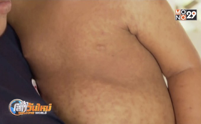 โรคหัดระบาดหนักในซามัว