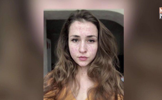 ชาวยูเครนไม่เชื่อมั่นวัคซีนป้องกันโรคหัด