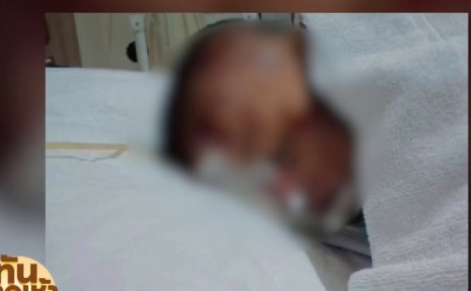 เด็ก 2 ขวบ ถูกสุนัขจรจัดกัดอาการสาหัส