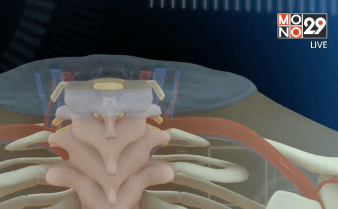 แพทย์อิตาลีผ่าตัดเปลี่ยนหัวลิงสำเร็จในจีน