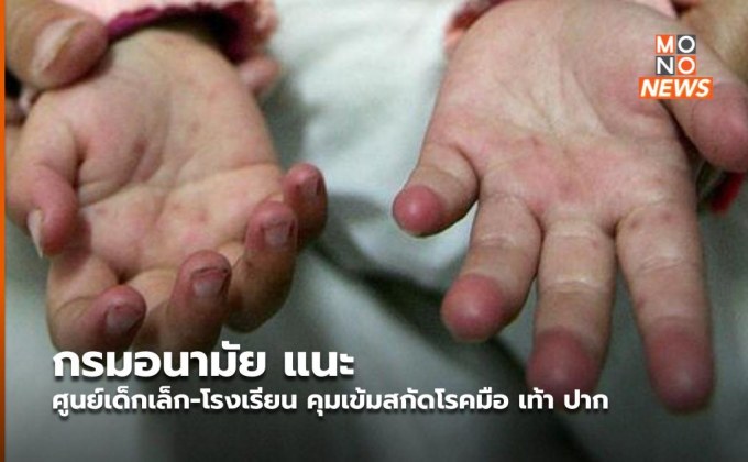 กรมอนามัย แนะ ศูนย์เด็กเล็ก-โรงเรียน คุมเข้มสกัดโรคมือ เท้า ปาก