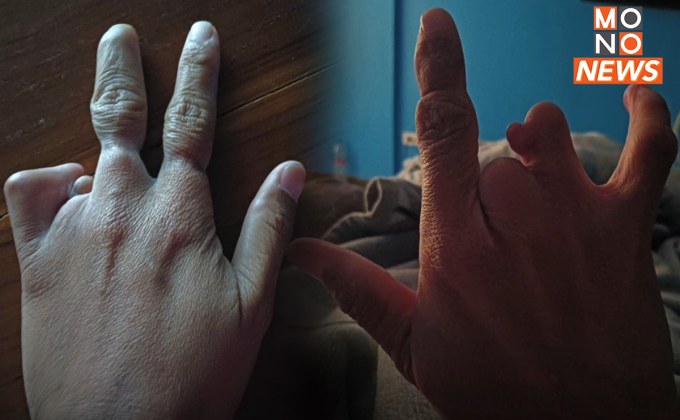 เพจดังโพสต์ภาพ มือพิการระดับไหน จึงได้สิทธิ?