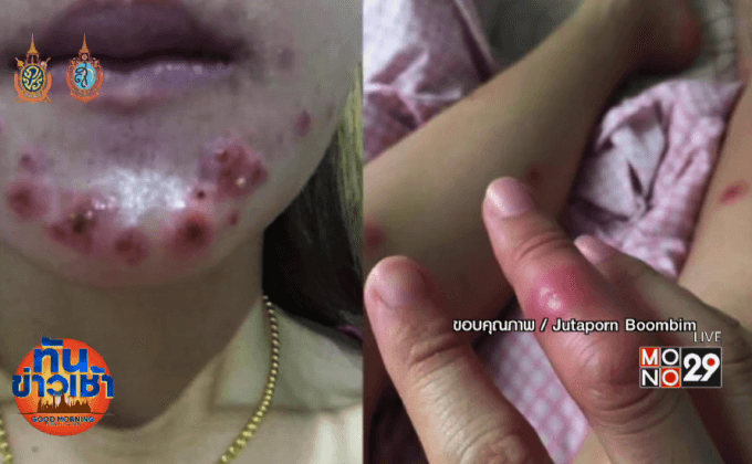 เตือนฉีดผิวขาวเสี่ยง “โรคหลอดเลือดอักเสบใต้ผิวหนัง”