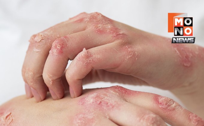 เตือนภัยโรคไข้ดิน ดับแล้ว 92 ราย เสี่ยงสูงช่วงน้ำท่วม