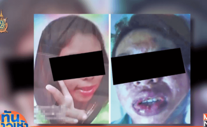 รพ.รามาฯ เร่งตรวจสาเหตุสาวทานอาหารเสริมดับ