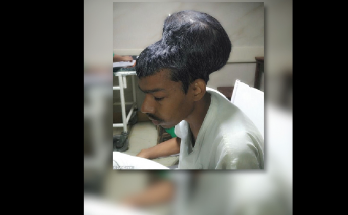 อินเดียผ่าตัดก้อนเนื้องอกสมองใหญ่สุดในโลก