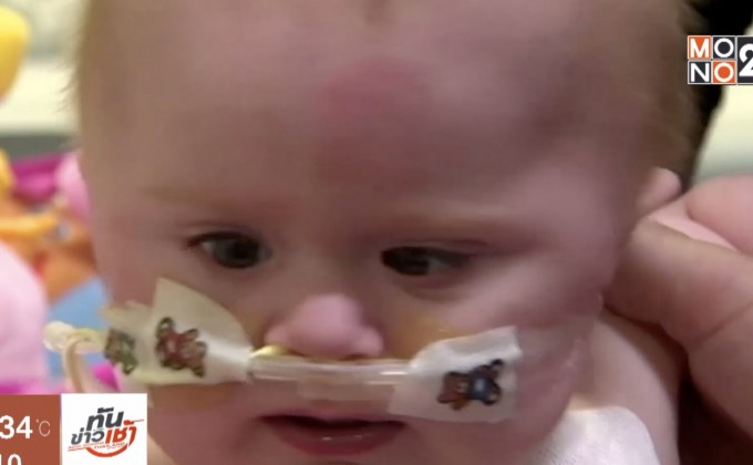 ทารกในอังกฤษที่มีหัวใจนอกทรวงอกกลับบ้านได้แล้ว