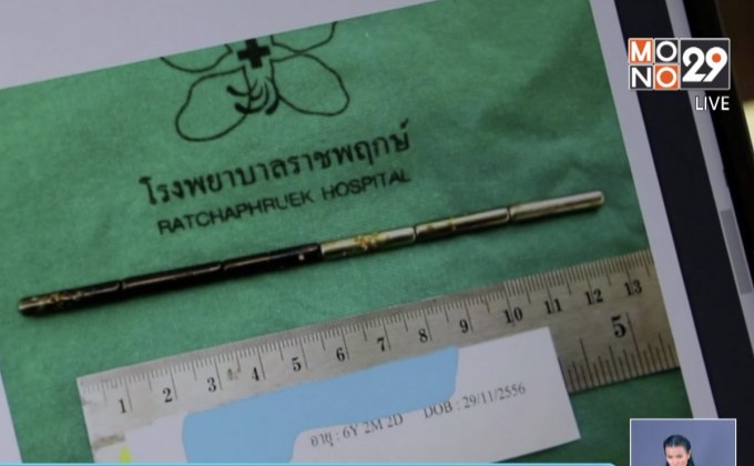 เด็ก 6 ขวบกลืนแม่เหล็กยาว 15 ซม.ลงท้อง