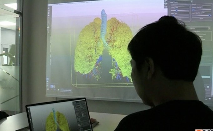 เทคโนโลยี 3D ช่วยแพทย์วางแผนผ่าตัด