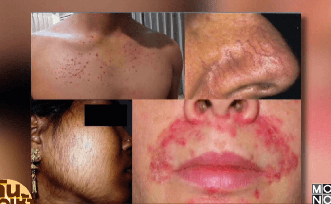 เตือนห้ามใช้ครีมสเตียรอยด์ หลังระบาดตามตลาดนัด