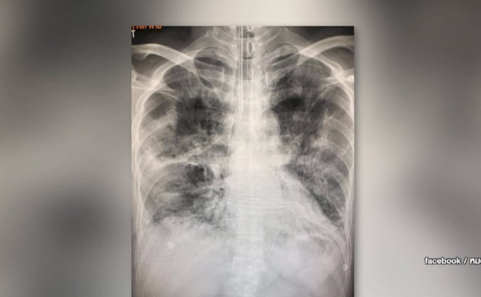 พบผู้ป่วยไข้หวัดใหญ่สายพันธุ์ A เสียชีวิตใน 30 วัน