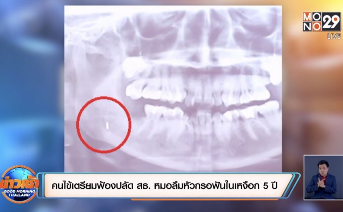 คนไข้เตรียมฟ้องปลัด สธ. หมอลืมหัวกรอฟันในเหงือก 5ปี