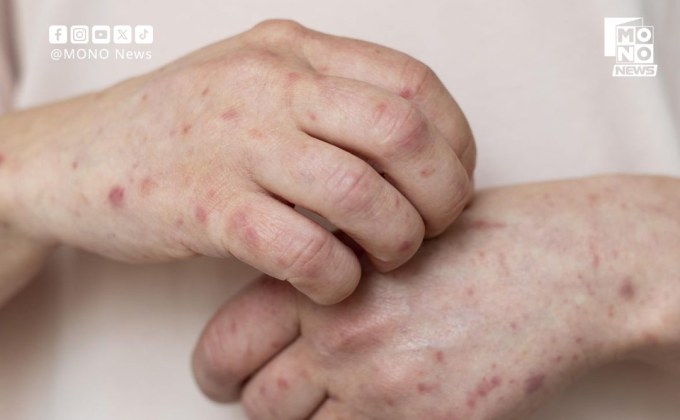 พบผู้ต้องขังต้องสงสัยติดฝีดาษลิง เรือนจำธนบุรีใช้ Bubble and Seal คุมเข้ม