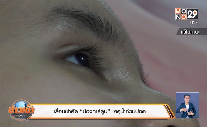 เลื่อนผ่าตัด “น้องการ์ตูน” เหตุน้ำท่วมปอด