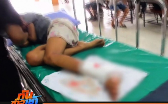 หวิดพิการ! ช่วยเด็กหญิงข้อเท้าติดล้อ จยย.