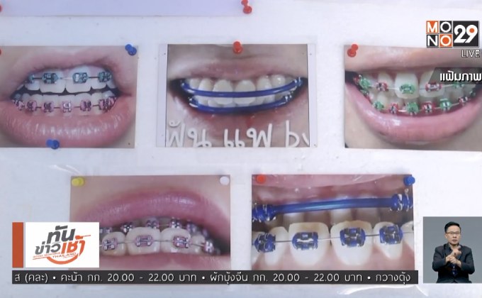 ทันตแพทยสภา ประกาศห้ามขายอุปกรณ์จัดฟันแฟชั่น