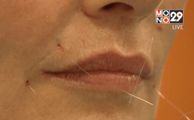 เทคนิคร้อยไหมยกกระชับใบหน้า