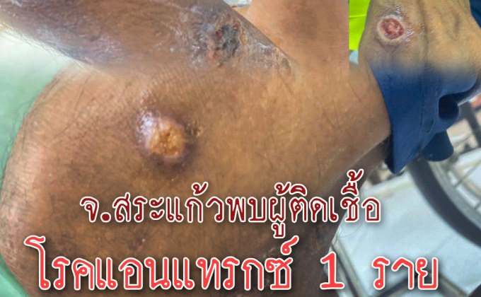 สระแก้วพบผู้ป่วยแอนแทรกซ์รายแรก สอบพบ ชอบกินซอยจุ๊ ก้อยดิบ