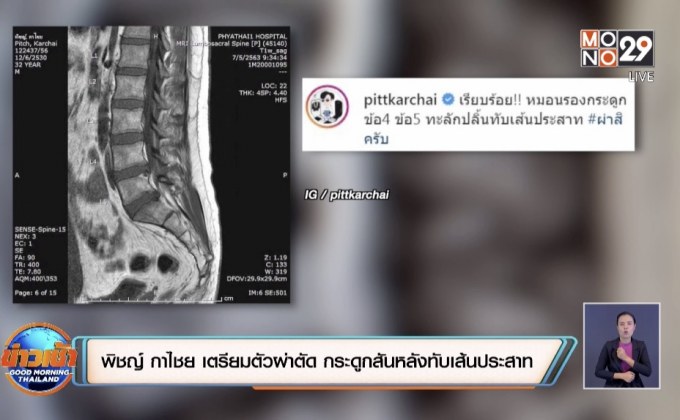 “พิชญ์ กาไชย” เตรียมตัวผ่าตัด กระดูกสันหลังทับเส้นประสาท