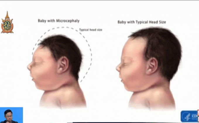 บริษัทในสหรัฐฯ เร่งพัฒนาวัคซีนไวรัสซิกา