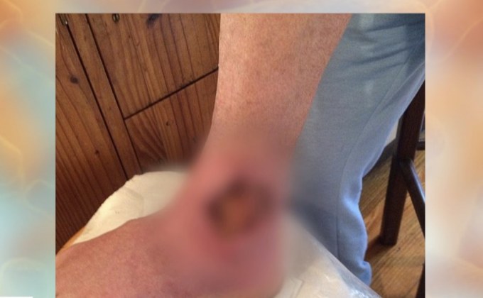 แผลจากแบคทีเรียกินเนื้อระบาดในออสเตรเลีย