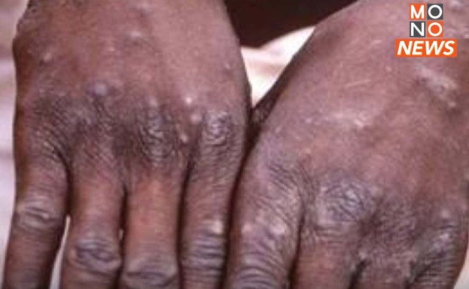 สธ. พบผู้ป่วยฝีดาษวานร เพิ่มอีก 3 คน ในไทย