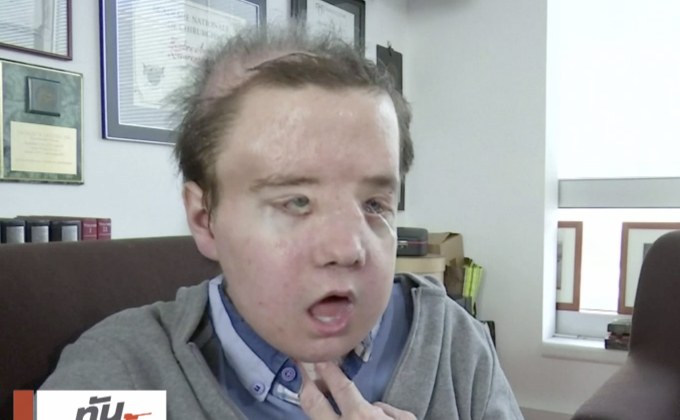 ชายชาวฝรั่งเศสได้รับการปลูกถ่าย “ใบหน้าที่ 3”