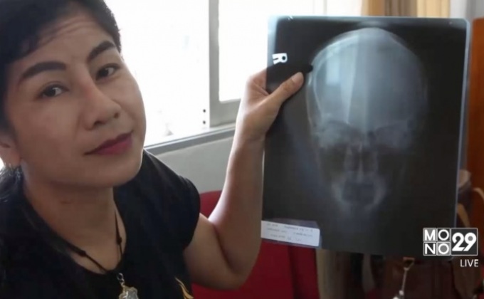 แจ้งความเอาผิดคลินิกศัลยกรรมจมูกผิดรูป