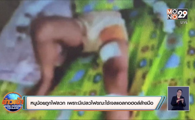 เด็ก 3 ขวบถูกไฟลวก เพราะมีเปลวไฟระหว่างล้างมือด้วยเจลแอลกอฮอล์