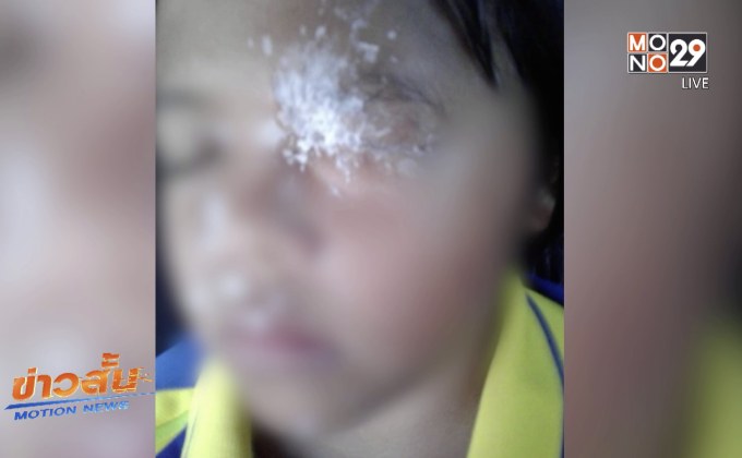 เด็กหญิงถูกกาวร้อนกระเด็นปิดทับดวงตาหวิดบอด
