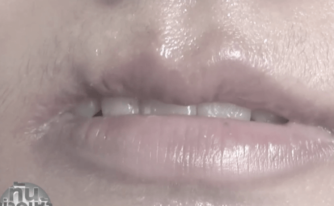 สาวแจ้งจับหมอศัลยกรรม ทำปากเบี้ยว ไม่รับผิดชอบ