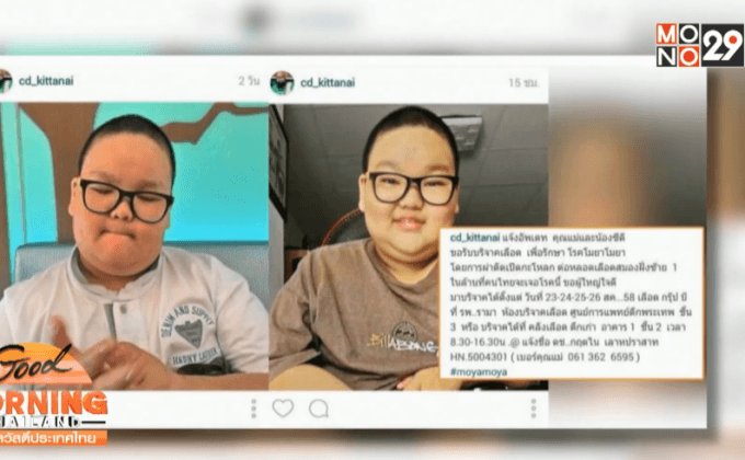 คนบันเทิงให้กำลังใจน้องซีดีป่วยโรคโมยาโมยา