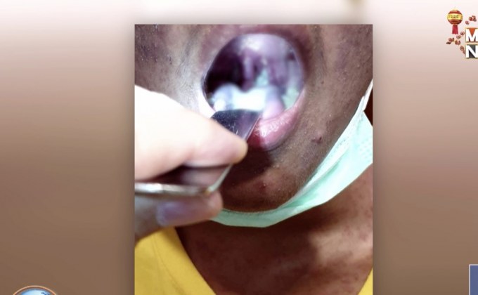 แพทย์เตือนโรคที่ติดต่อจากการจูบ