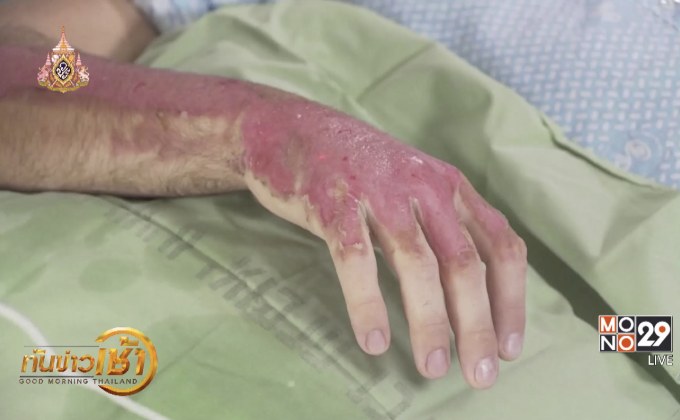 อุปกรณ์สร้างผิวหนังชั่วคราวเพื่อผู้ป่วยแผลไฟไหม้