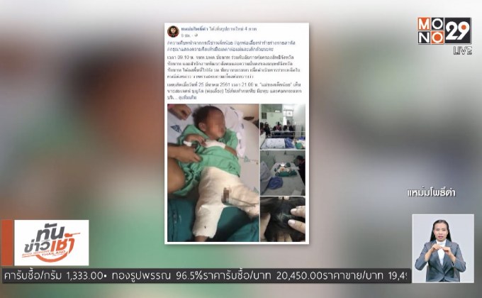 หนุ่มโหดทุบลูกเลี้ยง 2 ขวบ ขาหัก