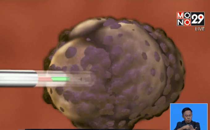 เทคนิครักษามะเร็งร้ายแรง